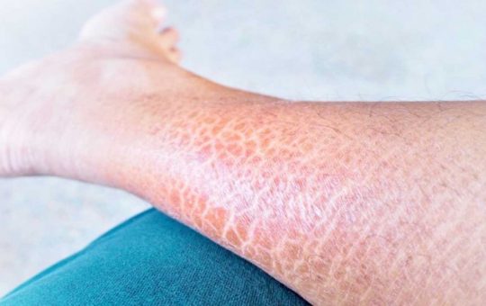 Gambe squamose, ecco il rimedio